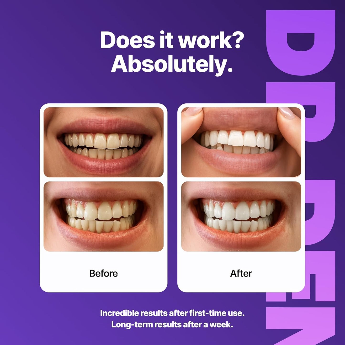 BrightSmile Whitening Strips Kit