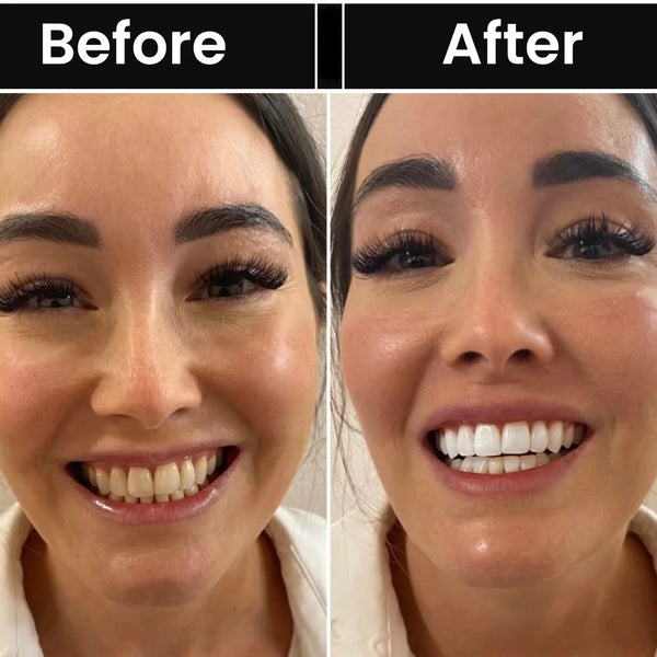 BrightSmile Whitening Strips Kit